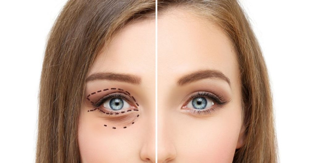 Blefaroplastia antes de los 40: por qué cada vez más mujeres
