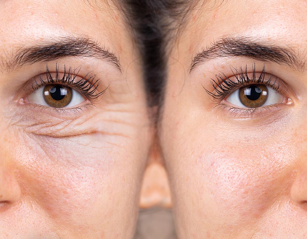 Blefaroplastia: lo que importa al rejuvenecer la mirada