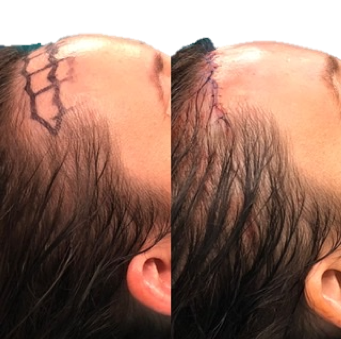 Frontoplastia en Barcelona con el Doctor Danilo Rivas