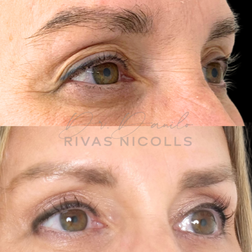 Blefaroplastia superior en Barcelona con Doctor Danilo Rivas