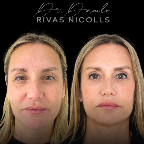 Blefaroplastia superior en Barcelona con Doctor Danilo Rivas