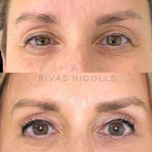 Blefaroplastia superior en Barcelona con Doctor Danilo Rivas