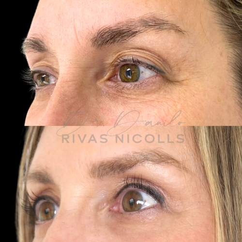 Blefaroplastia superior en Barcelona con Doctor Danilo Rivas